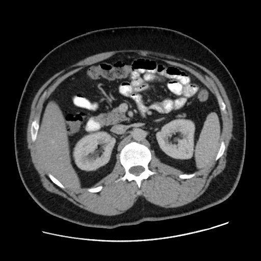 File:Acute diverticulitis with localized perforation (Radiopaedia 41296-44113 Axial C+ portal venous phase 34).jpg