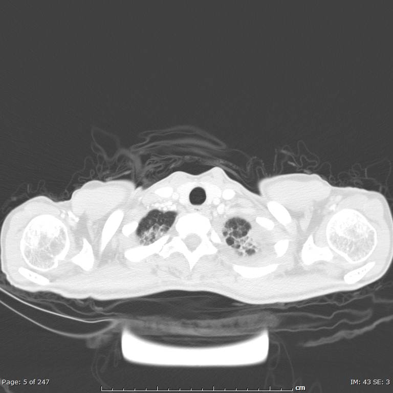 Acute eosinophilic pneumonia (Radiopaedia 48211-53073 Axial lung window 2).jpg
