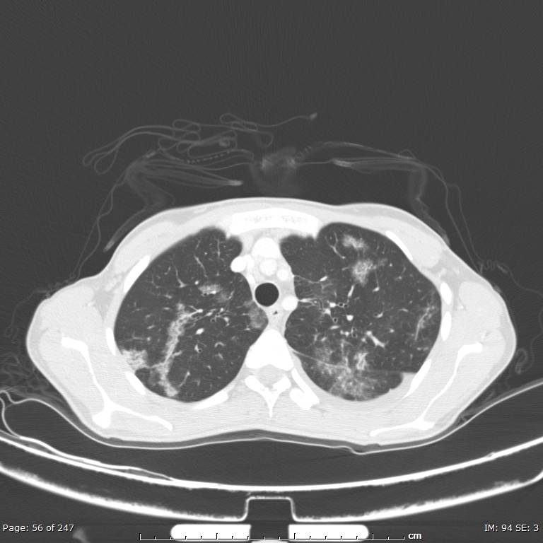 Acute eosinophilic pneumonia (Radiopaedia 48211-53073 Axial lung window 20).jpg