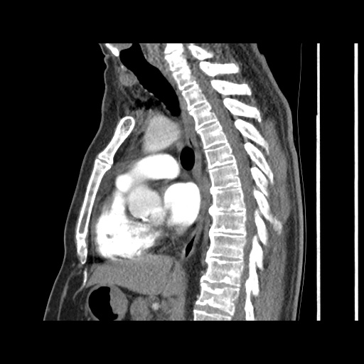 Acute epicardial fat necrosis (Radiopaedia 42327-45440 Sagittal C+ CTPA 38).jpg