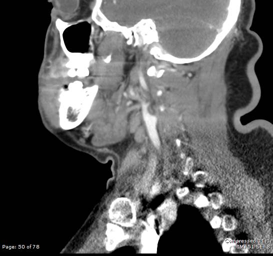 Acute epiglottitis (Radiopaedia 54375-60590 Sagittal C+ arterial phase 50).jpg