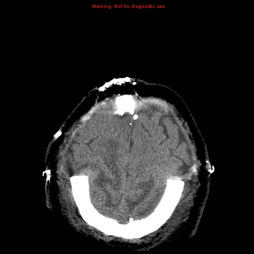 Acute hemorrhagic leukoencephalitis (Radiopaedia 14076-43697 Axial non-contrast 44).jpg