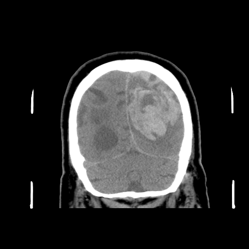 Acute hemorrhagic stroke (Radiopaedia 17507-17223 Coronal non-contrast 46).jpg