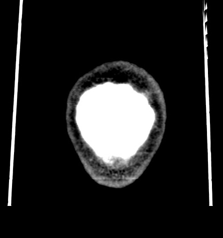 Acute left anterior cerebral artery territory infarction (Radiopaedia 51785-57578 Coronal non-contrast 60).jpg