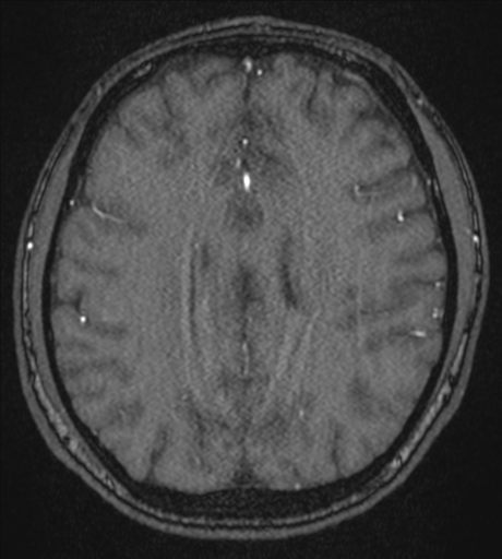 Acute left middle cerebral artery territory infarct with clot retrieval (Radiopaedia 47732-52433 Axial MRA 43).png