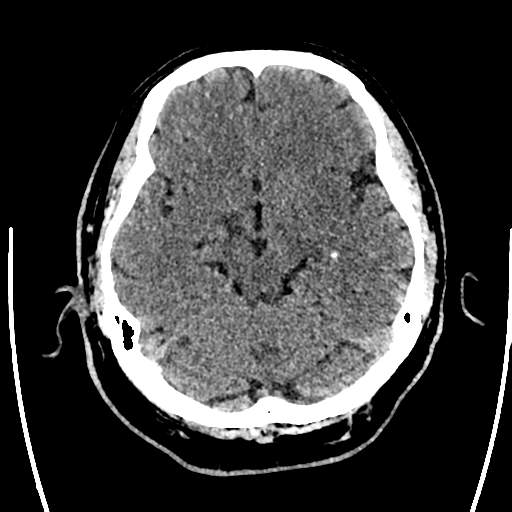 Acute left middle cerebral artery territory ischemic stroke (Radiopaedia 35688-37223 Axial non-contrast 29).png