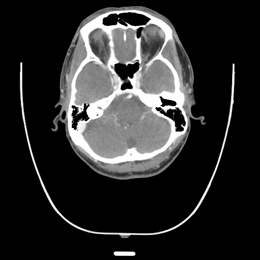 Acute longus colli calcific tendinitis (Radiopaedia 72495-83036 Axial C+ arterial phase 1).jpg