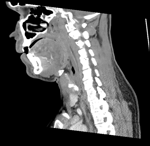 Acute longus colli calcific tendinitis (Radiopaedia 72495-83036 Sagittal C+ arterial phase 26).jpg
