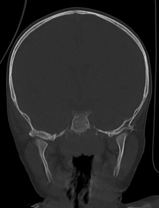 Acute mastoiditis (Radiopaedia 82678-96881 Coronal bone window 36).jpg