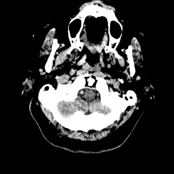 Acute middle cerebral artery territory infarct (Radiopaedia 52380-58283 Axial non-contrast 4).jpg