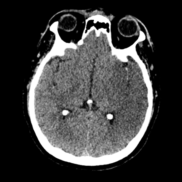 Acute middle cerebral artery territory infarct (Radiopaedia 52380-58283 Axial non-contrast 47).jpg