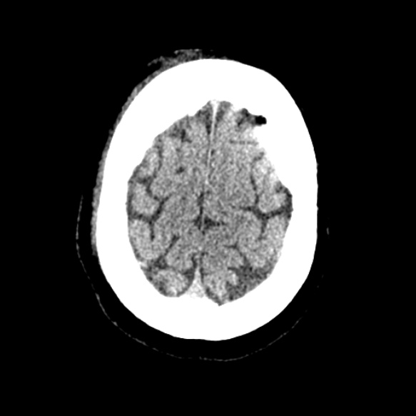 Acute middle cerebral artery territory infarct (Radiopaedia 52380-58283 Axial non-contrast 92).jpg