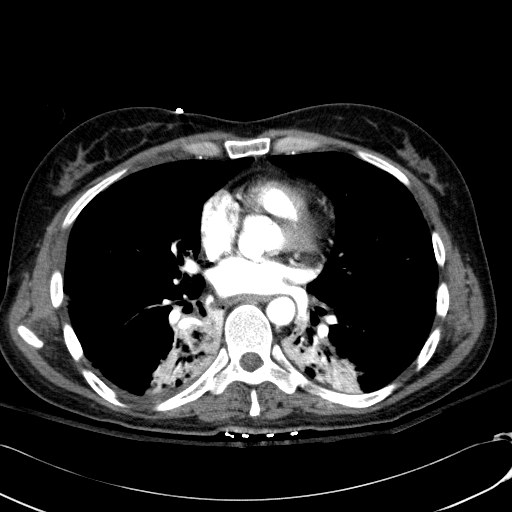 Acute myocardial infarction in CT (Radiopaedia 39947-42415 Axial C+ arterial phase 78).jpg