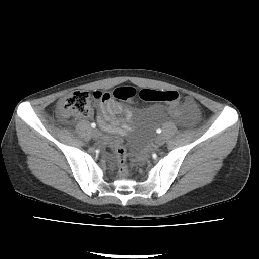 File:Acute myocarditis (Radiopaedia 55988-62613 Axial C+ portal venous phase 61).jpg