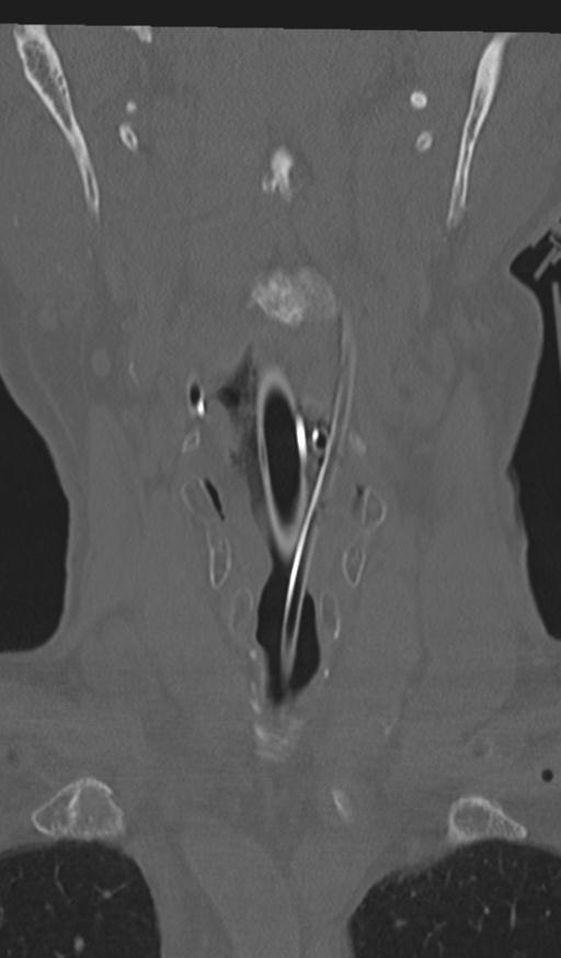 Acute on chronic subdural hematoma and thoracic vertebral injury in a multitrauma patient (Radiopaedia 31698-32619 Coronal bone window 6).jpg