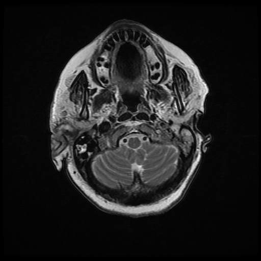 File:Acute otitis externa (Radiopaedia 57296-64236 Axial T2 10).jpg