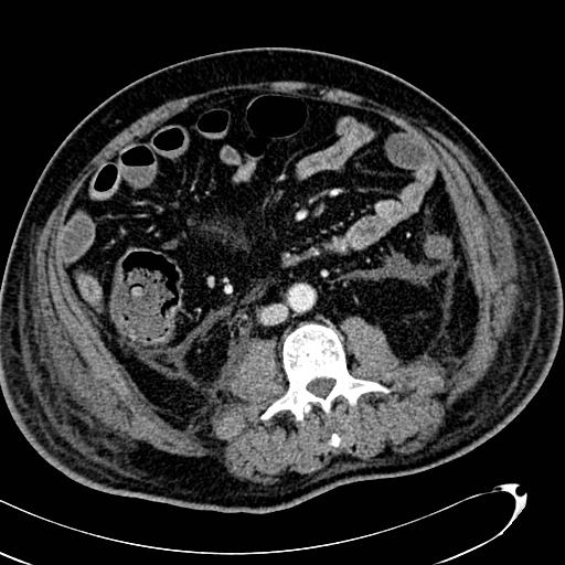 File:Acute pancreatic necrosis (Radiopaedia 13560-13486 Axial C+ portal venous phase 89).jpg