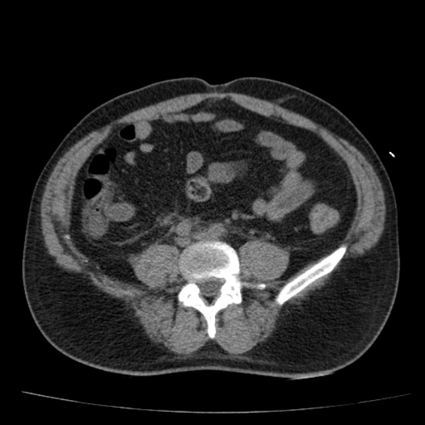 Acute pancreatitis (Radiopaedia 26663-26813 Axial non-contrast 66).jpg