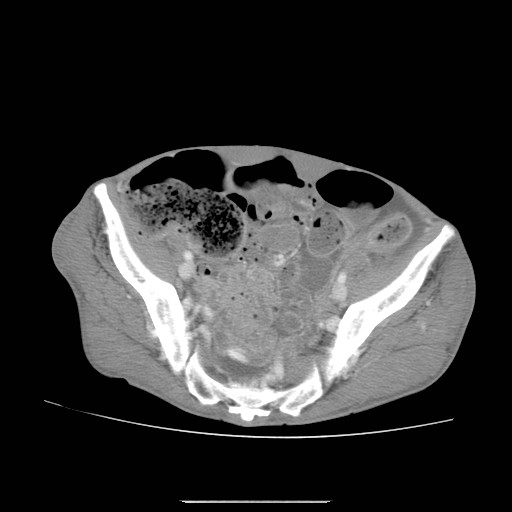 File:Acute pancreatitis (Radiopaedia 50213-55558 Axial C+ portal venous phase 48).jpg