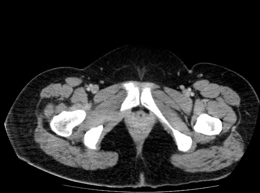 Acute pancreatitis (Radiopaedia 69236-79012 Axial C+ portal venous phase 91).jpg