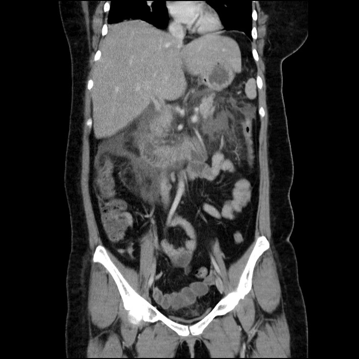 Acute pancreatitis (Radiopaedia 69236-79012 Coronal C+ portal venous phase 41).jpg