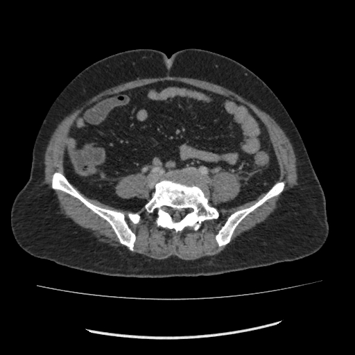 Acute pancreatitis (Radiopaedia 80007-93285 Axial C+ portal venous phase 116).jpg