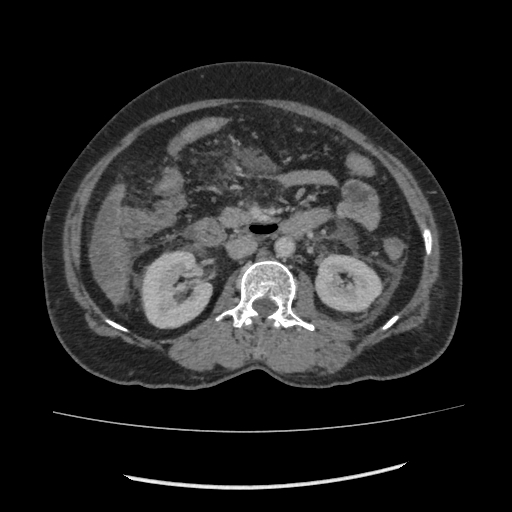 Acute pancreatitis (Radiopaedia 80007-93285 Axial C+ portal venous phase 88).jpg