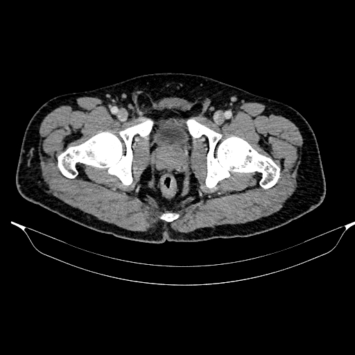File:Acute pancreatitis (Radiopaedia 87428-103757 Axial C+ portal venous phase 94).jpg