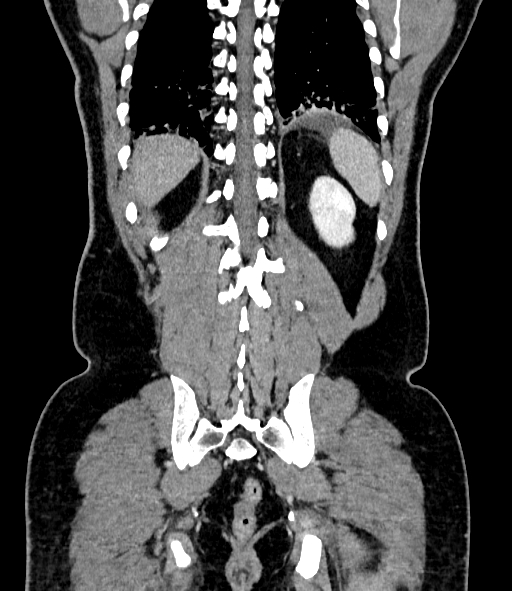 Acute pancreatitis (Radiopaedia 87428-103757 Coronal C+ portal venous phase 75).jpg