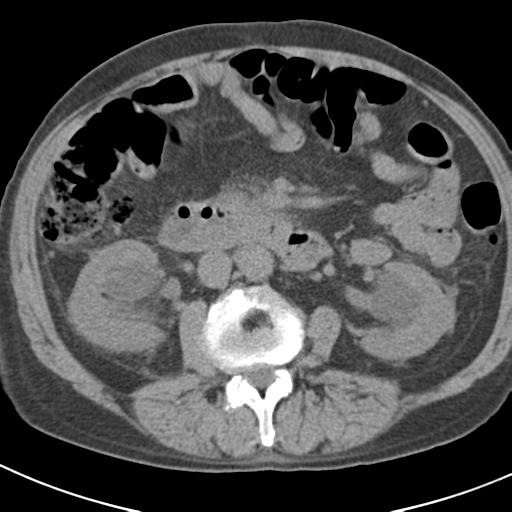 File:Acute pancreatitis and walled-off necrosis (Radiopaedia 29888-30403 Axial non-contrast 34).jpg