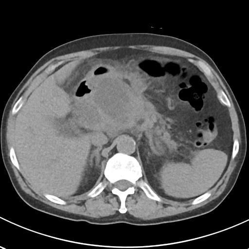 File:Acute pancreatitis and walled-off necrosis (Radiopaedia 29888-30404 Axial non-contrast 22).jpg
