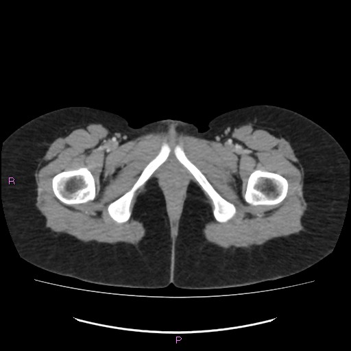 File:Acute pancreatitis secondary to stone at minor papilla and pancreatic divisum (Radiopaedia 76570-88333 Axial C+ portal venous phase 87).jpg