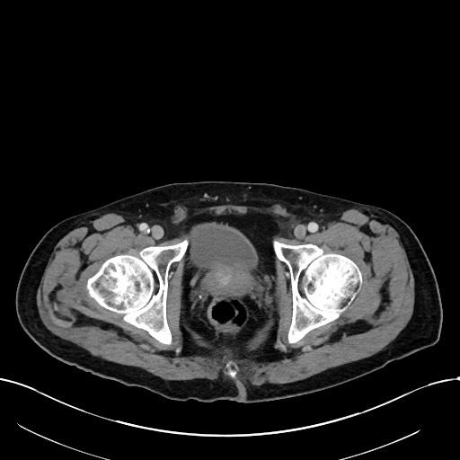 Acute renal infarction (Radiopaedia 59375-66736 Axial C+ portal venous phase 114).jpg