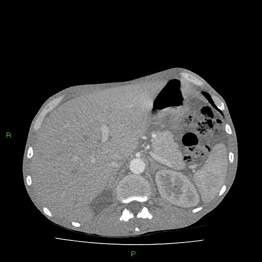 File:Acute right lung abscess (Radiopaedia 34806-36258 Axial C+ arterial phase 186).jpg