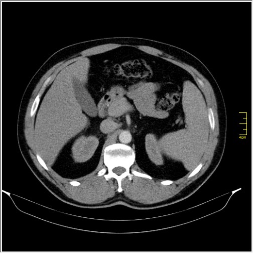 Acute right sided diverticulitis (Radiopaedia 65249-74268 Axial C+ portal venous phase 23).JPG