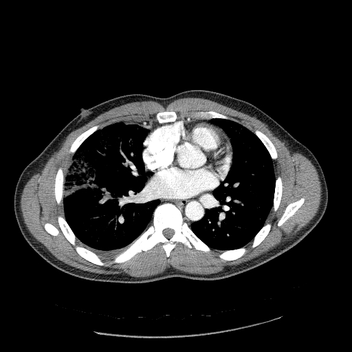 File:Acute segmental pulmonary emboli and pulmonary infarction (Radiopaedia 62264-70444 Axial C+ CTPA 66).jpg