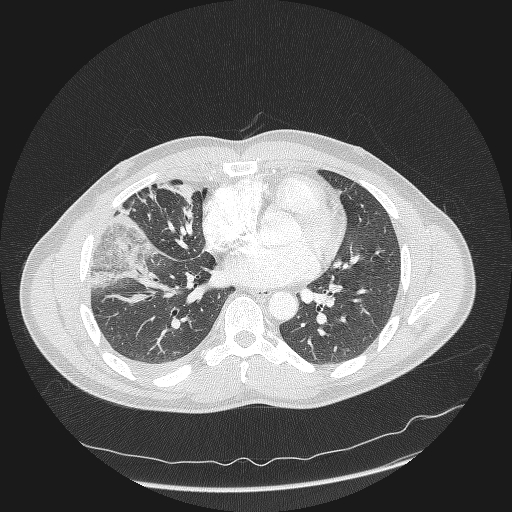 Acute segmental pulmonary emboli and pulmonary infarction (Radiopaedia 62264-70444 Axial lung window 113).jpg