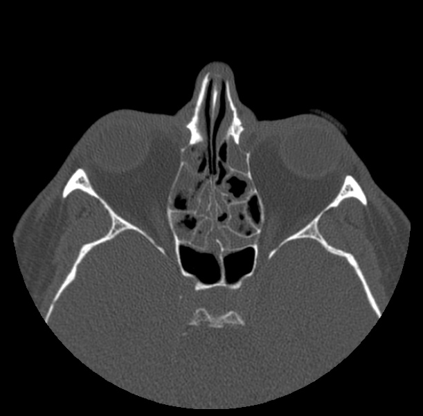 Acute sinusitis (Radiopaedia 23161-23215 Axial bone window 42).jpg