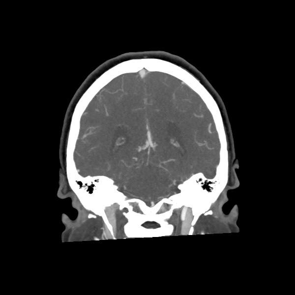 File:Acute subarachnoid hemorrhage and accessory anterior cerebral artery (Radiopaedia 69231-79009 Coronal C+ arterial phase 54).jpg