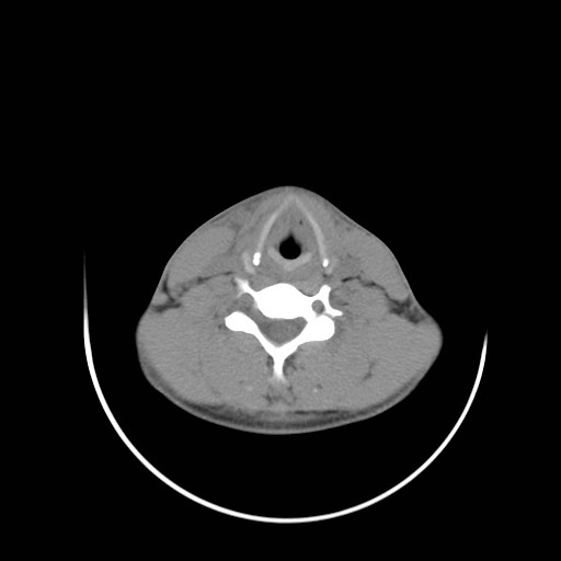 File:Acute submandibular sialadenitis secondary to ductal stone (Radiopaedia 27999-28267 Axial non-contrast 24).jpg