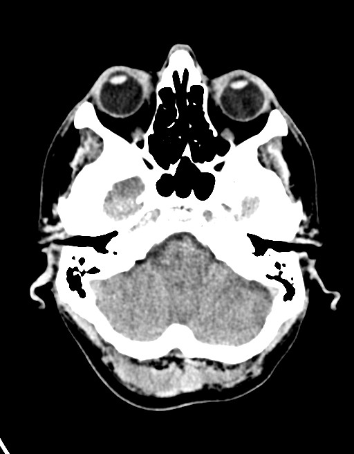 Acute superior cerebellar artery territory infarct (Radiopaedia 84104-99359 Axial non-contrast 54).jpg