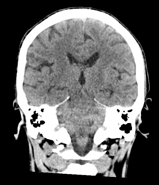 File:Acute superior cerebellar artery territory infarct (Radiopaedia 84104-99359 Coronal non-contrast 55).jpg