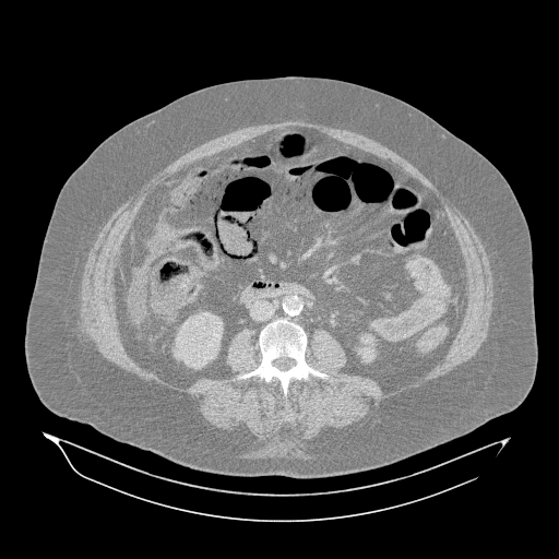 Acute superior mesenteric artery occlusion (Radiopaedia 51288-56960 Axial lung window 33).jpg