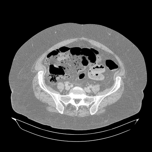 File:Acute superior mesenteric artery occlusion (Radiopaedia 51288-56960 Axial lung window 53).jpg