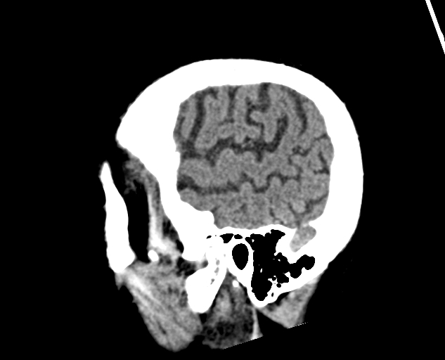 Acute traumatic subdural hematoma (Radiopaedia 82921-97257 Sagittal non-contrast 60).jpg