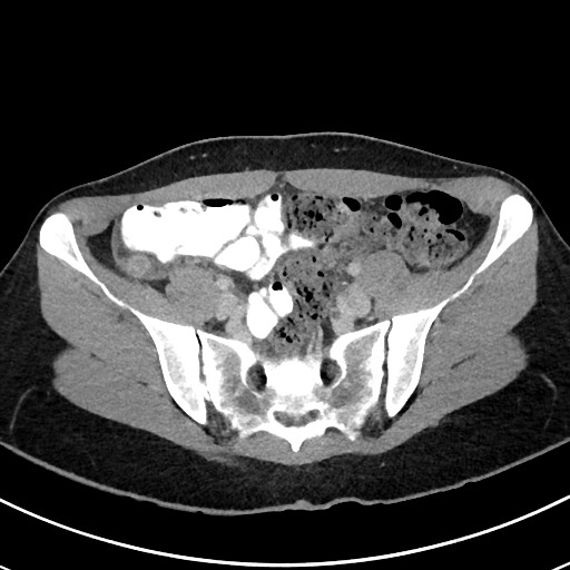 File:Acute uncomplicated appendicitis (Radiopaedia 61374-69304 Axial 32).jpg