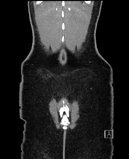 Acute uncomplicated appendicitis (Radiopaedia 61374-69304 Coronal C+ portal venous phase 101).jpg