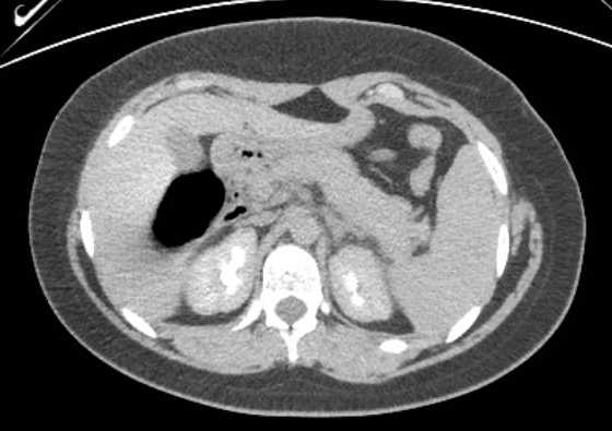 Acute unilateral nonhemorrhagic adrenal infarction (Radiopaedia 67560-76957 Axial renal excretory phase 34).jpg