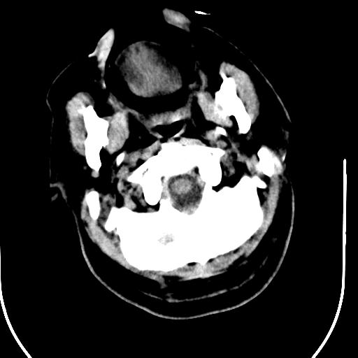 Acute vertebrobasilar ischemic infarction (Radiopaedia 25220-25473 Axial non-contrast 5).jpg