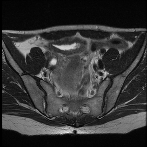 File:Adenocarcinoma arising in a urethral diverticulum (Radiopaedia 12400-12657 Axial T2 3).jpg